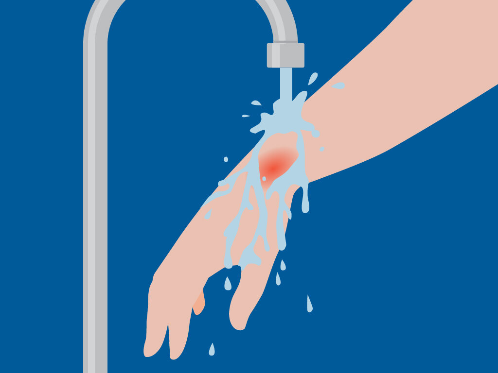 Eerste hulp - brandwonden